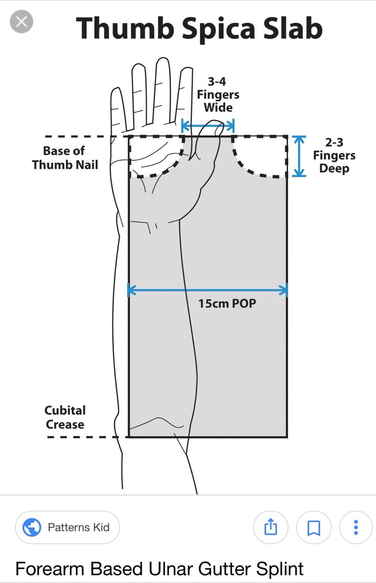 Pintheresa Mclaughlin On Ot Ideas | Hand Therapy, Hand Therapy within Printable Thumb Spica Splint Pattern